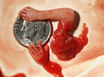 Ребёнок, убитый абортом на 10-й неделе