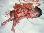 Ребёнок, убитый абортом на 22-й неделе