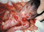 Ребёнок, убитый абортом на 22-й неделе
